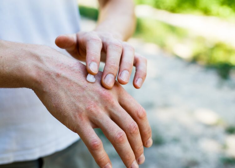 Study: Exposure to Air Pollution, Genetic Susceptibility, and Psoriasis Risk in the UK. Image Credit: Ternavskaia Olga Alibec / Shutterstock