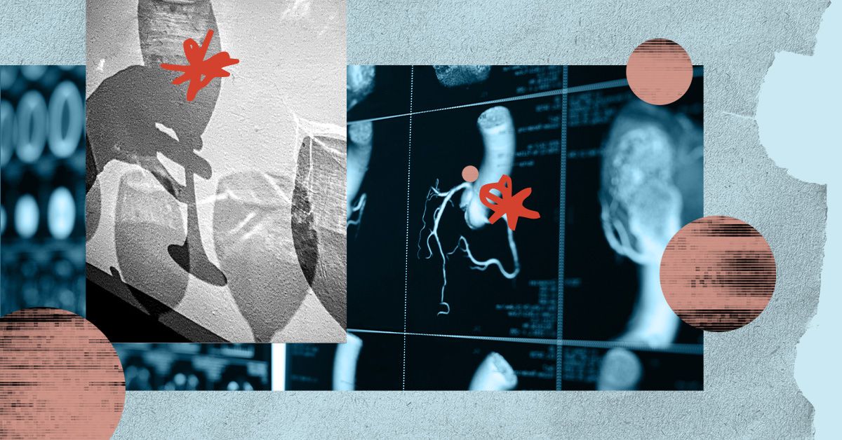 La consommation d’alcool peut provoquer une fibrillation auriculaire et d’autres problèmes cardiaques
