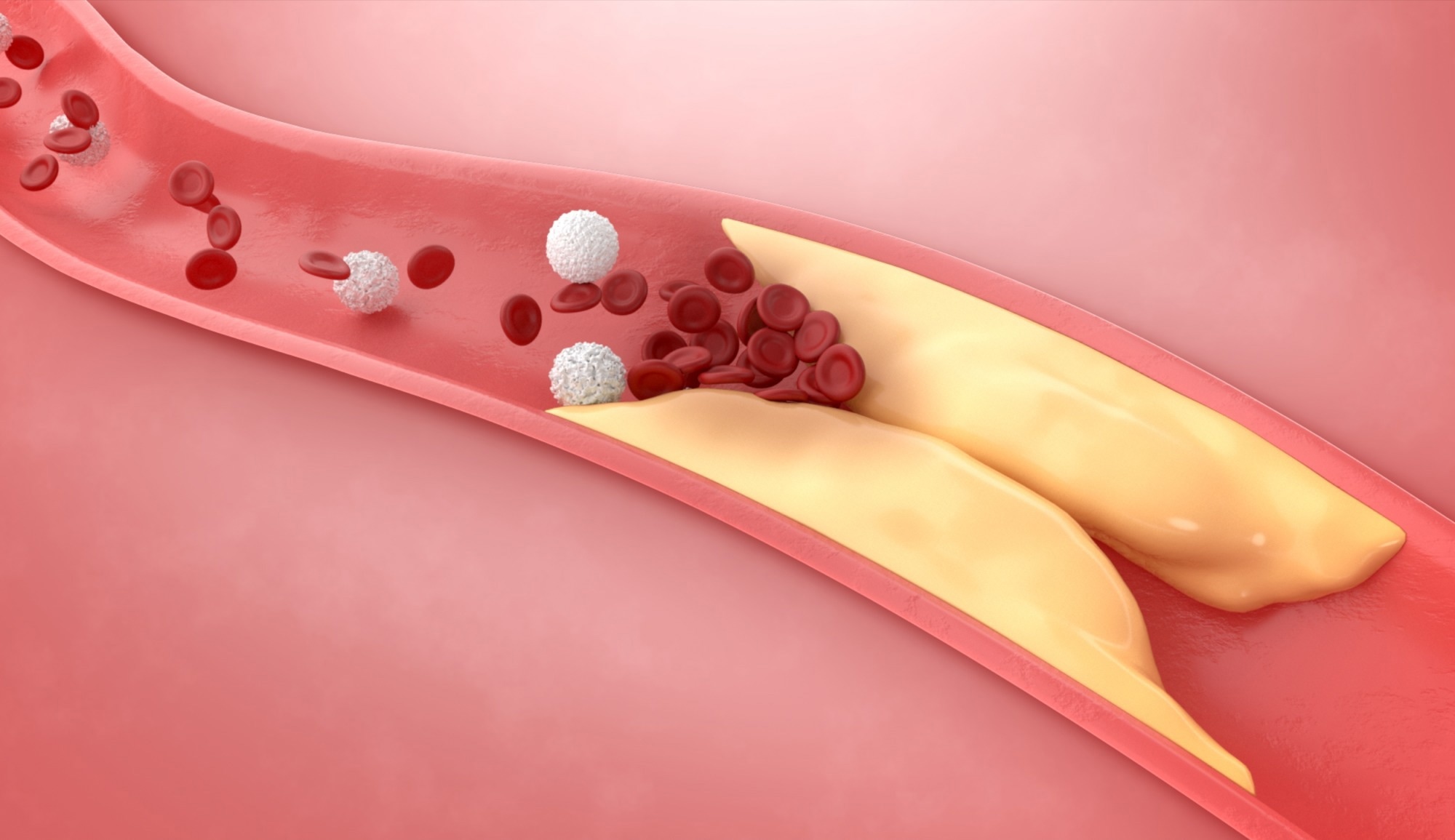 Study: Association of remnant cholesterol with risk of dementia: a nationwide population-based cohort study in South Korea. Image Credit: NPW-STUDIO/Shutterstock.com