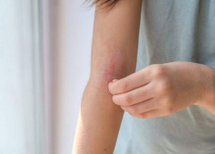 Study: Long-Term Use of Oral Corticosteroids and Safety Outcomes for Patients With Atopic Dermatitis. Image Credit: Evgeniia Primavera/Shutterstock.com