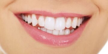Que faire après avoir réalisé un kit de blanchiment dentaire ?