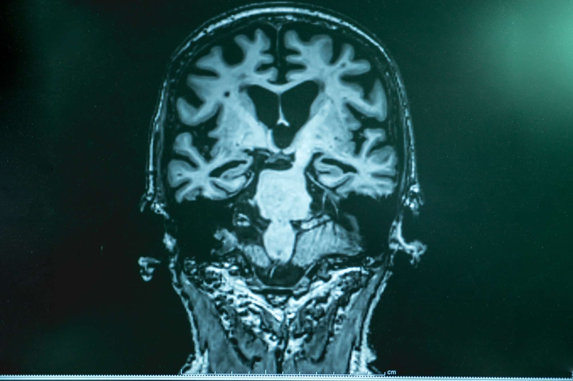 Study: The global macroeconomic burden of Alzheimer