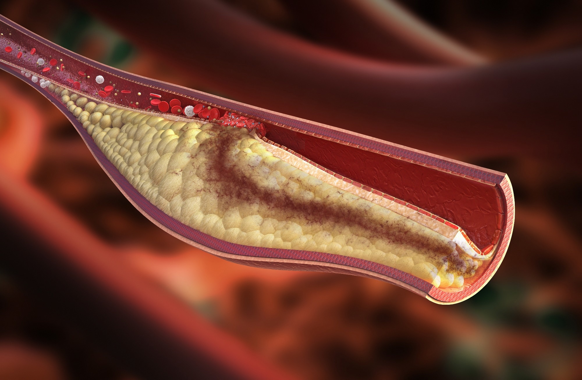 Study: Lesion-Level Effects of LDL-C–Lowering Therapy in Patients With Acute Myocardial Infarction. Image Credit: Rocos / Shutterstock