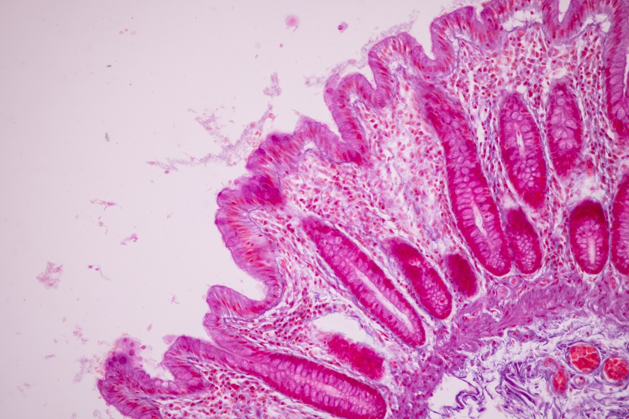 Study: Food antigens suppress small intestinal tumorigenesis. Image Credit: Sinhyu Photographer / Shutterstock.com