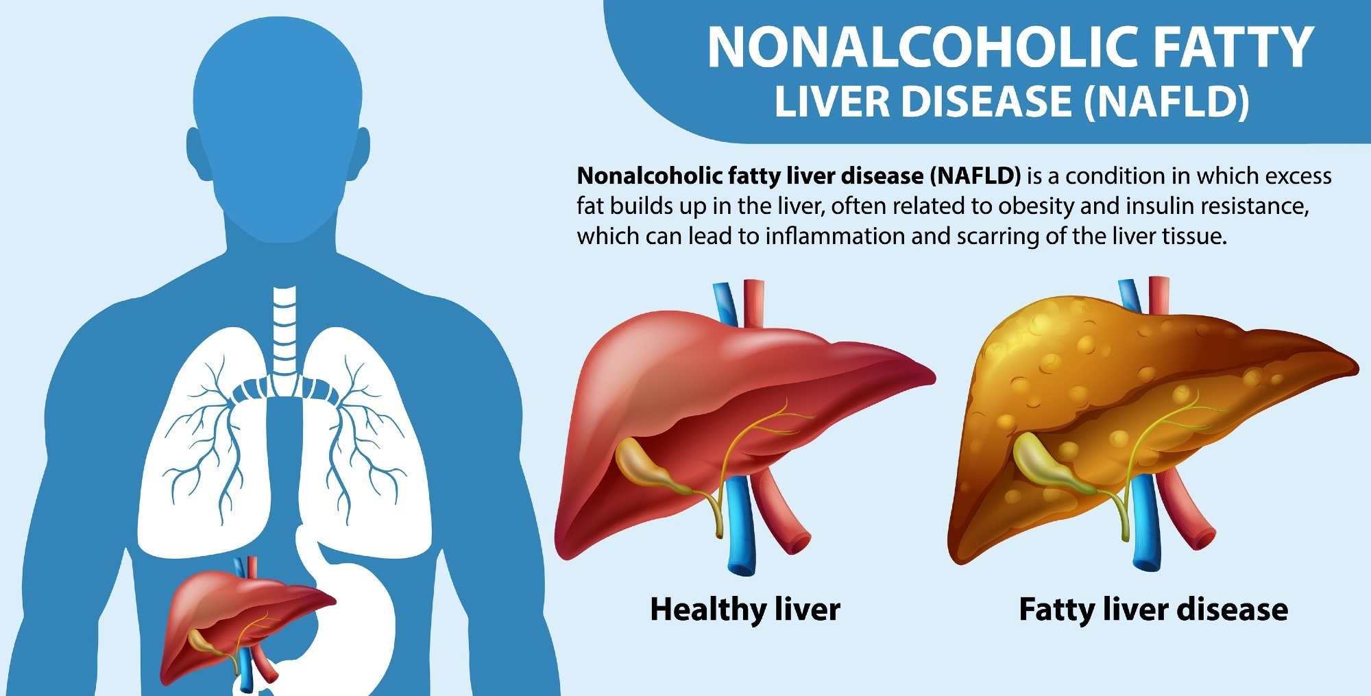 Study: Soft drink consumption and increased risk of nonalcoholic fatty liver disease: Results from the health workers cohort study. Image Credit: BlueRingMedia / Shutterstock