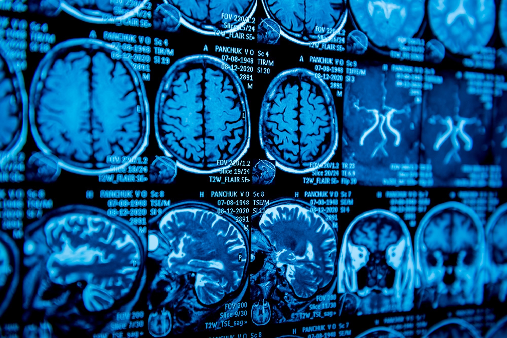 Study: Gene expression differences associated with alcohol use disorder in human brain. Image Credit: Roman Zaiets / Shutterstock