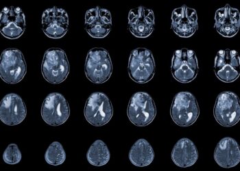 MRI brain axial view showing an isodense mass with ill-defined margins and surrounding edema in the right frontal lobe, consistent with glioblastoma and brain metastasis