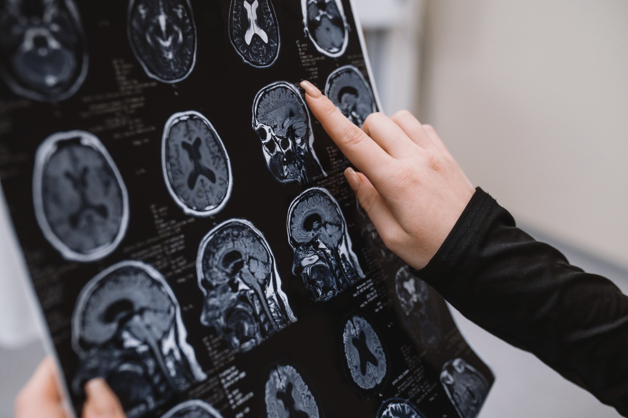L'IRM portable et l'IA améliorent le diagnostic de la maladie d ...