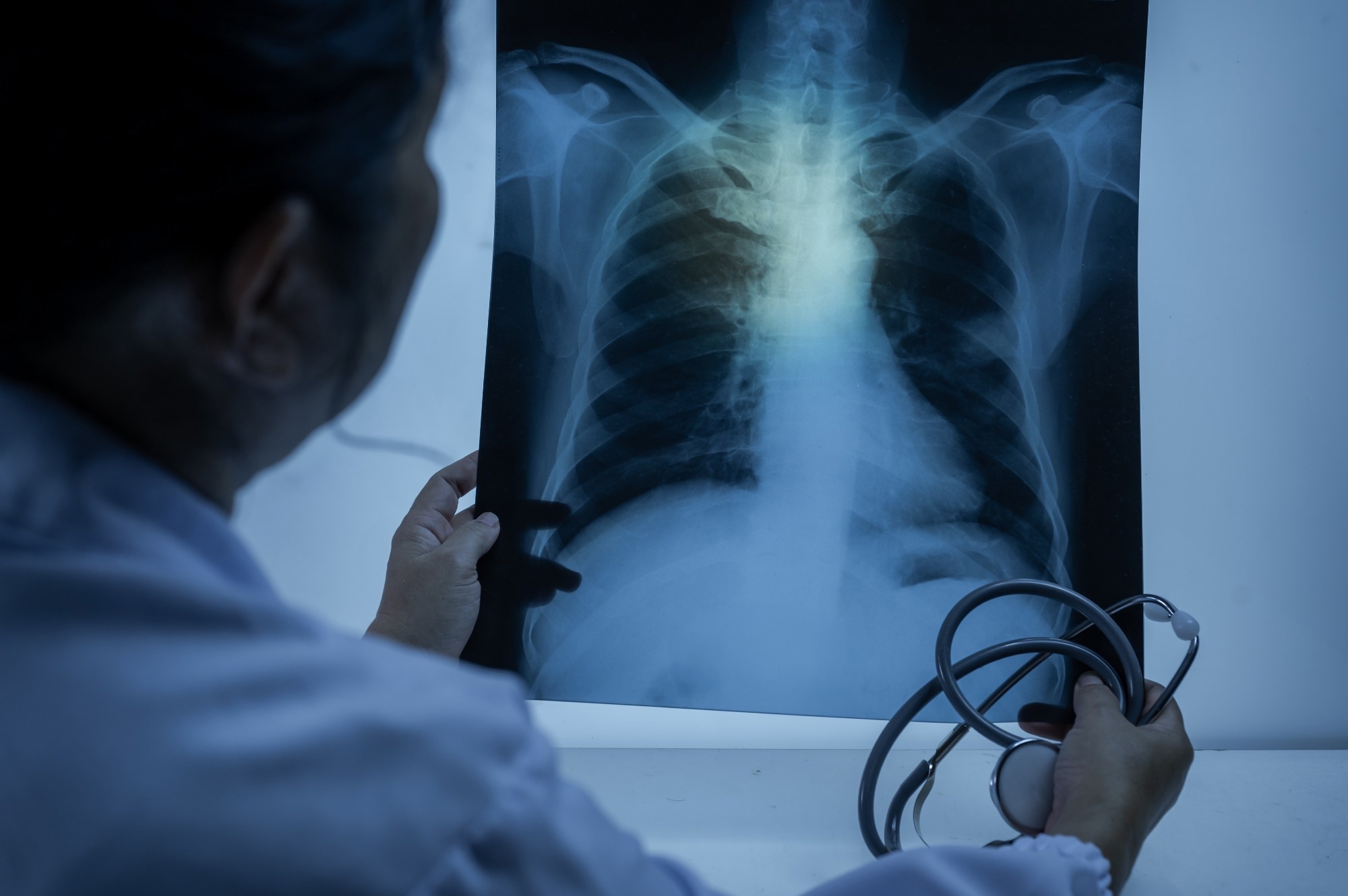 L'association Quabodepistat semble prometteuse pour un traitement plus sûr et plus rapide de la tuberculose