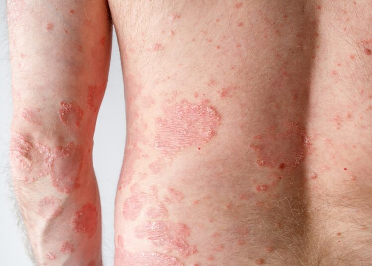 Les aliments ultra-transformés augmentent le risque de psoriasis actif, selon une étude