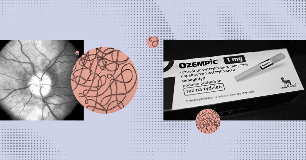 Des études danoises révèlent un risque plus élevé de lésions du nerf optique avec Ozempic
