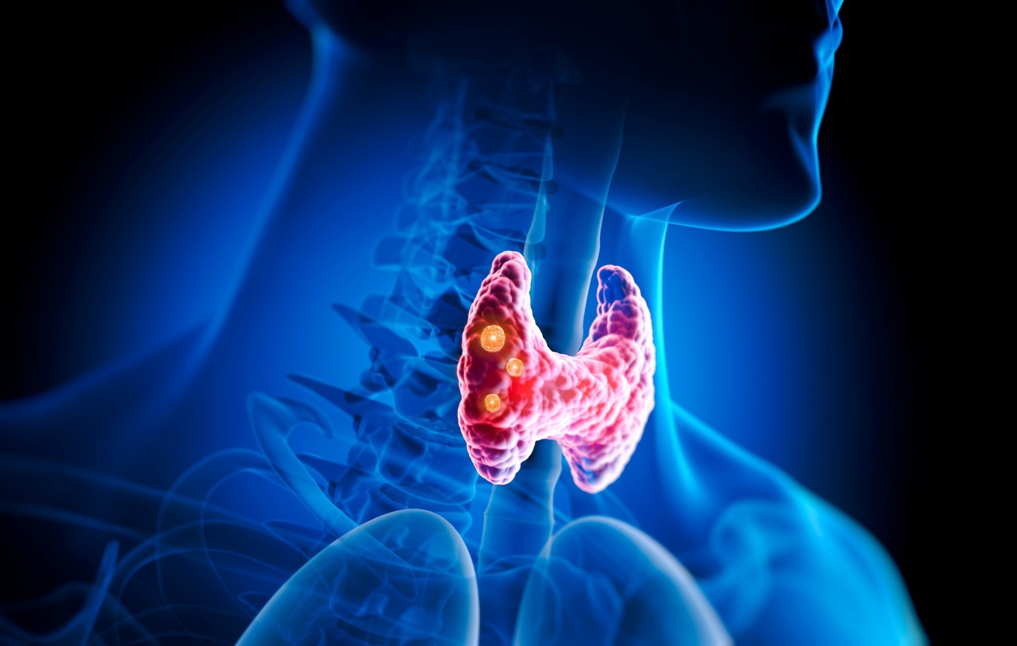 Initiation GLP-1R liée à de nouveaux diagnostics de cancer de la thyroïde