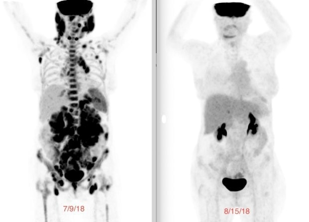 Image de la TEP montrant une analyse avant et après le traitement des cellules T CAR. À gauche, un scan avec de nombreuses tumeurs présentes et à droite, aucune preuve de maladie.