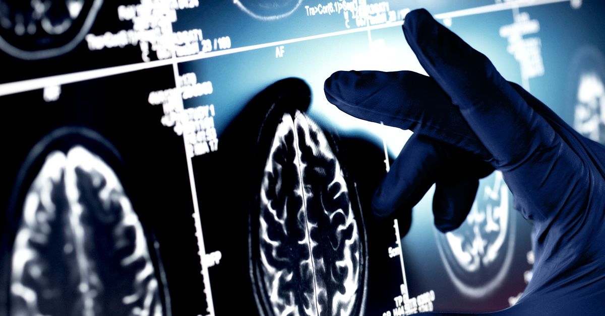 Ce que «s'échapper» d'un homme d'Alzheimer pourrait nous dire sur la maladie