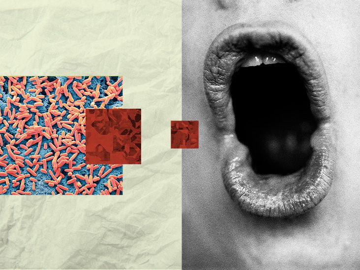 Certaines bactéries dans la bouche peuvent jouer un rôle dans la perte de mémoire et la démence