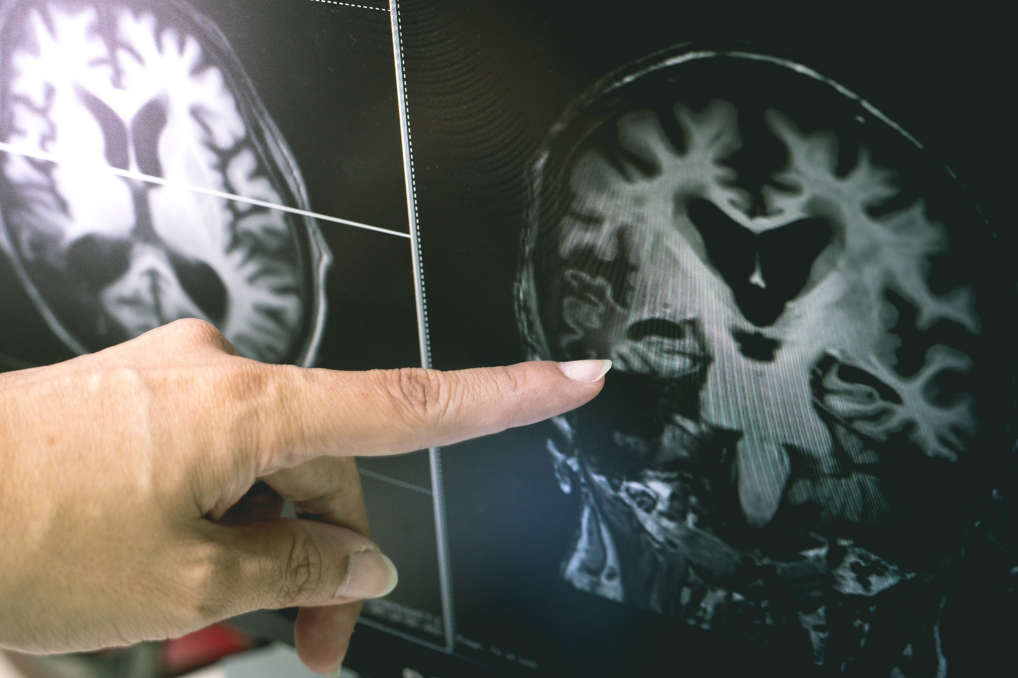 Les gènes de risque d'autisme liés aux changements de substance blanche à la naissance, façonnant le développement du cerveau précoce