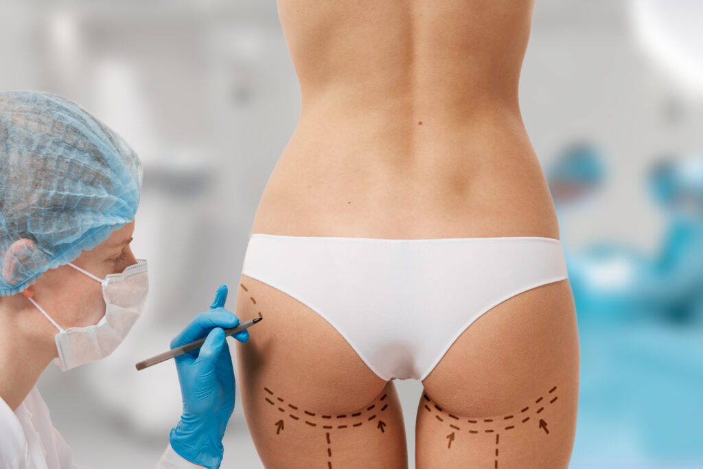 Lipofilling fessier : la technique naturelle pour des fesses galbées et harmonieuses