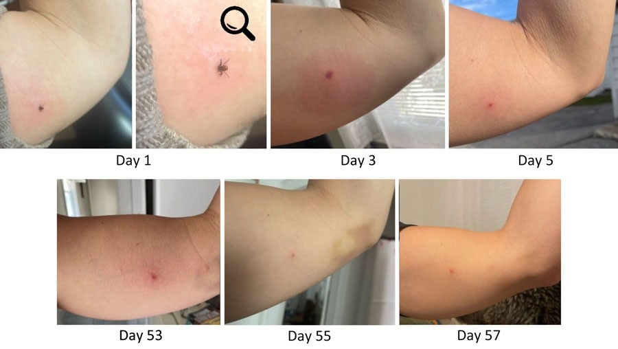 Progression et persistance de la réaction du site de la morsure dans le syndrome alpha-gal après Ixodes Scapularis Tick Pigch, Maine, USA, 2022. A) Jour 1, Attaché Ixodes Scapularis Adult Female; B) Version agrandie de l'image dans le panneau A; grossissement × 2,1; C) Jour 3, érythème croissant autour du site de piqûre de tique entourant accompagné de prurit intenses et croissants; D) Jour 5, site de morsure moins enflammé et avec la gale; E) Jour 53, le patient a repris la documentation photo en raison du prurit persistant et des «fusées éclairantes» de la lésion devenant intermittente; F) Jour 55, la lésion s'est améliorée; G) Jour 57, lésion légèrement relevée à nouveau, photo prise pour documenter la variation. Après ces photos, le prurit a largement résolu. En décembre 2024, le site de morsure reste identifiable comme une papule asymptomatique.