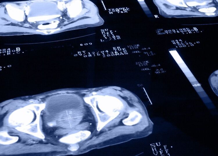 Aller à des dépistages peut réduire le risque de mortalité par le cancer de la prostate de 23%