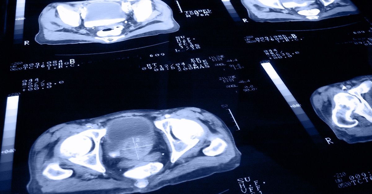 Aller à des dépistages peut réduire le risque de mortalité par le cancer de la prostate de 23%