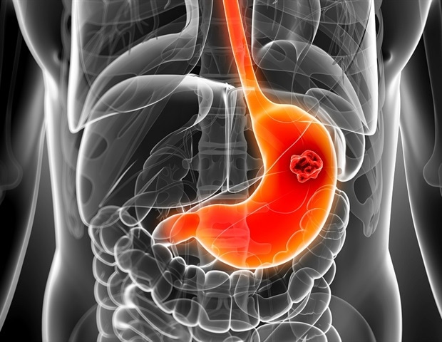 Les scientifiques découvrent les indices d'une nouvelle cause potentielle de cancer de l'estomac