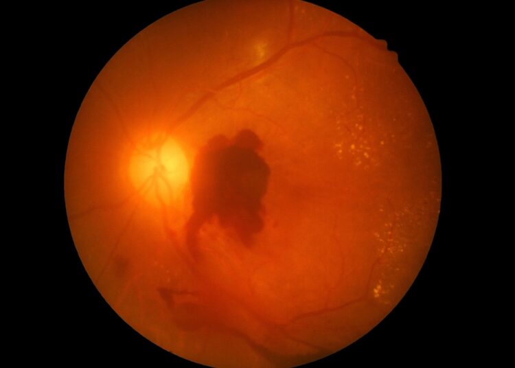 Study: Increased vision impairment reports linked to semaglutide: analysis of FDA adverse event data. Image Credit: memorisz / Shutterstock