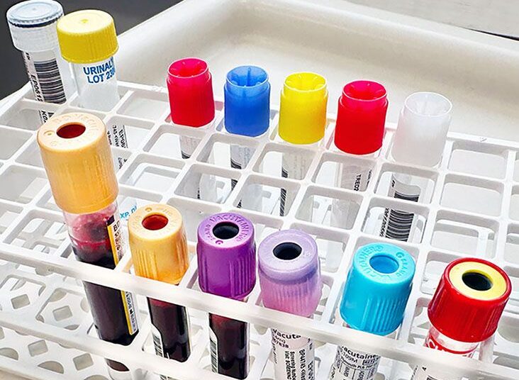 Test tubes of blood for a clinical trial at a hospital