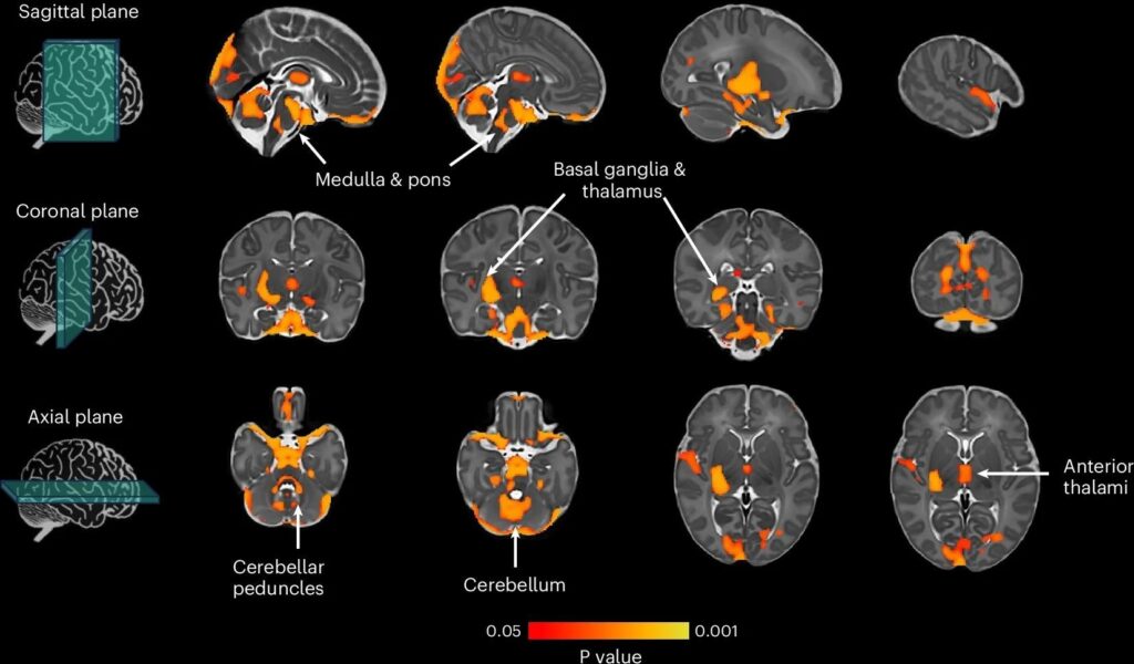 Thresholding t-statistic image at t > 0.95 (two-sided statistical test). Significant voxels were overlaid on the 40-week neonatal brain template in sagittal, coronal and axial planes. White arrows indicate significant brain structures involved in motor control. N = 264. Study: Genome-wide association meta-analysis of age at onset of walking in over 70,000 infants of European ancestry
