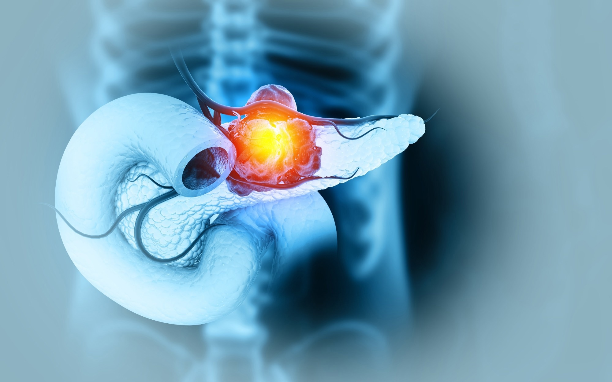 Study: Alcohol intake and pancreatic cancer risk: An analysis from 30 prospective studies across Asia, Australia, Europe, and North America. Image Credit: crystal light / Shutterstock