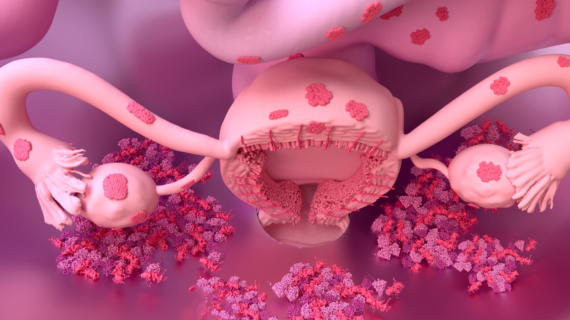 Endométriose liée à des chances plus élevées de conditions auto-immunes