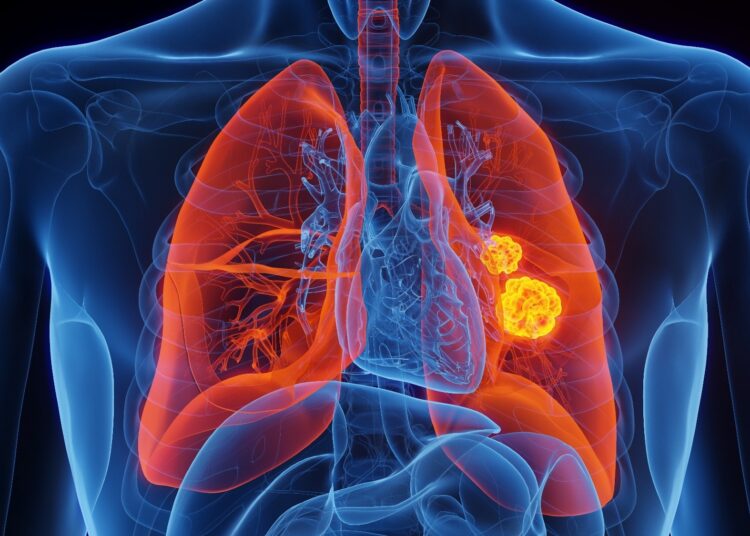 Does postoperative plasma IL-6 improve early prediction of infection after pulmonary cancer surgery? A two-centre prospective study. Image Credit: 3dMediSphere / Shutterstock