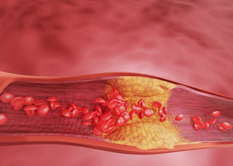 atherosclerosis, and heart disease problems in human blood vessels. 3D rendering