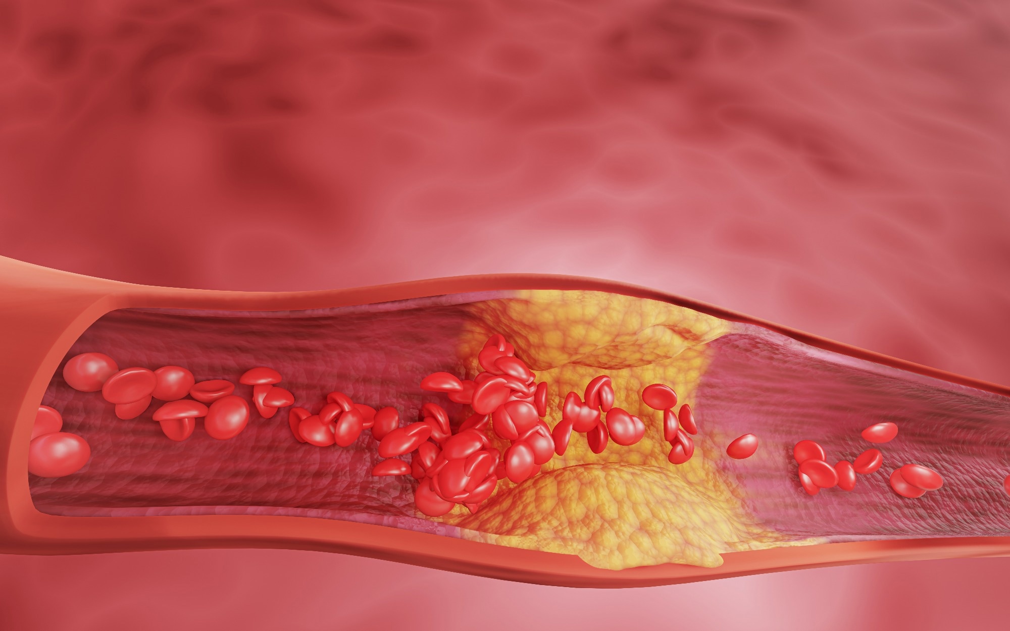 atherosclerosis, and heart disease problems in human blood vessels. 3D rendering