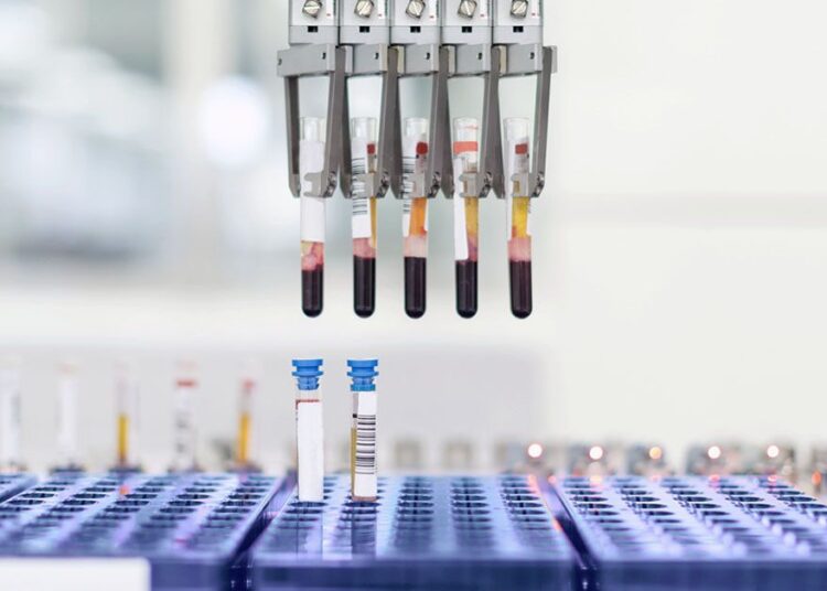 Le test de résistance à l'insuline peut aider à prédire le taux de déclin cognitif d'Alzheimer
