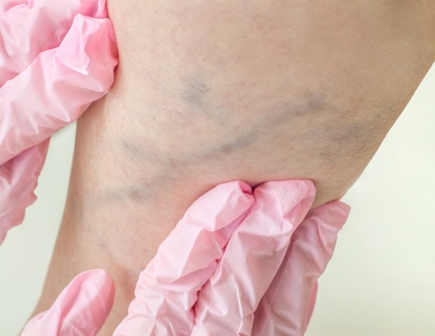 Prédire la thrombose veineuse profonde chez les patients atteints d'un cancer de l'ovaire épithélial à l'aide d'un nomogramme