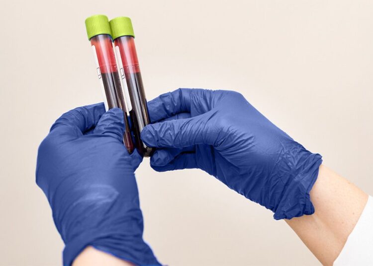 Un nouveau test sanguin pourrait diagnostiquer la maladie cœliaque sans déclencher de symptômes