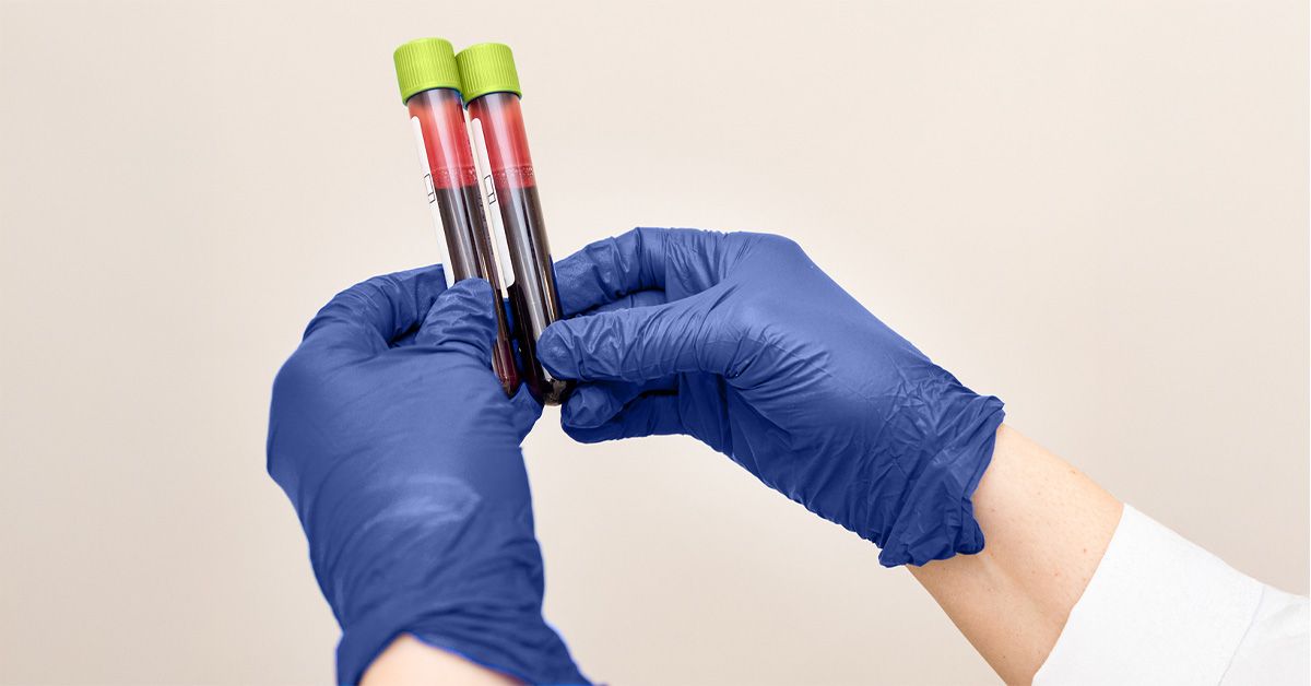 Un nouveau test sanguin pourrait diagnostiquer la maladie cœliaque sans déclencher de symptômes