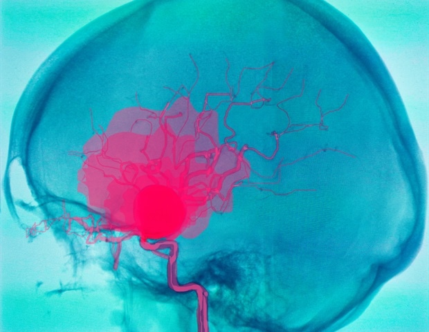 L'embolisation de l'anévrisme neuroendovasculaire assisté robotique montre des résultats prometteurs de 6 mois