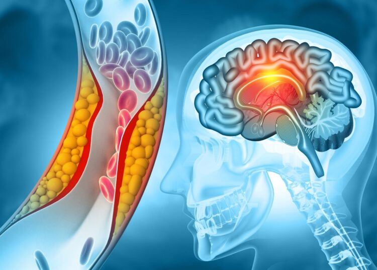 Study: Inhibition of GAPDH aggregation as a potential treatment for acute ischemic stroke. Image Credit: crystal light / Shutterstock