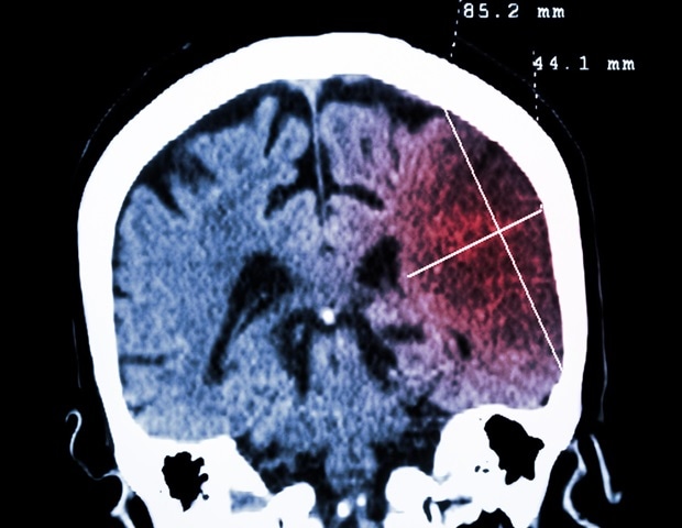 Les agrégats de polyglycine perturbent l'épissage de l'ARNt et la neurodégénérescence