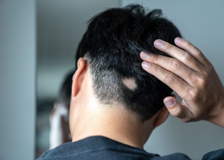 Study: Serotonin activates dermal papilla cells and promotes hair growth. Image Credit: Suthikait Teerawattanaphan / Shutterstock