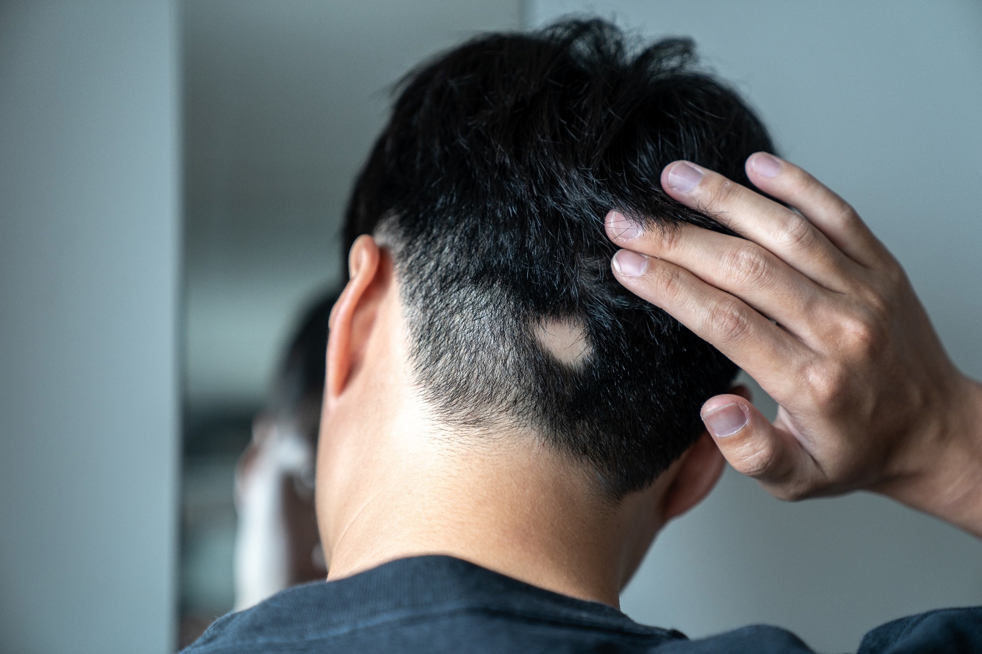 Study: Serotonin activates dermal papilla cells and promotes hair growth. Image Credit: Suthikait Teerawattanaphan / Shutterstock