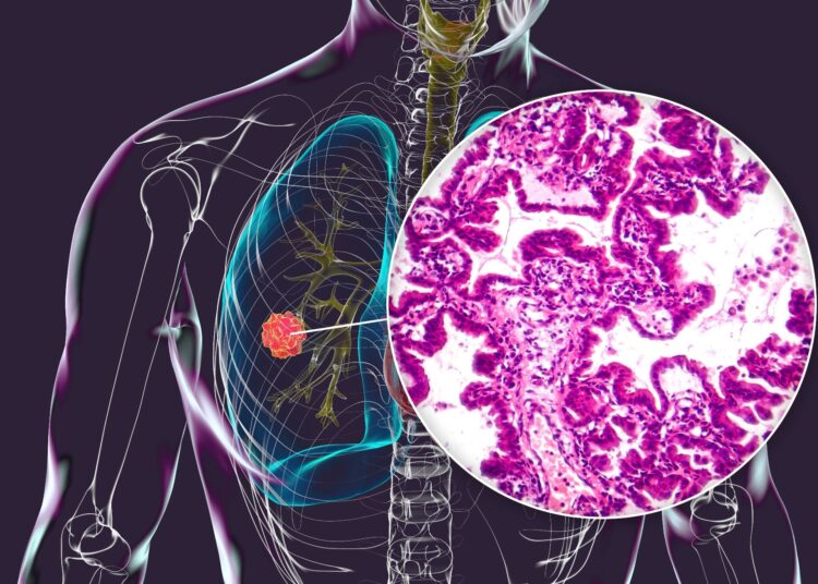 A human body with transparent skin showcasing lung cancer, 3D illustration complemented by a light micrograph of the lung adenocarcinoma