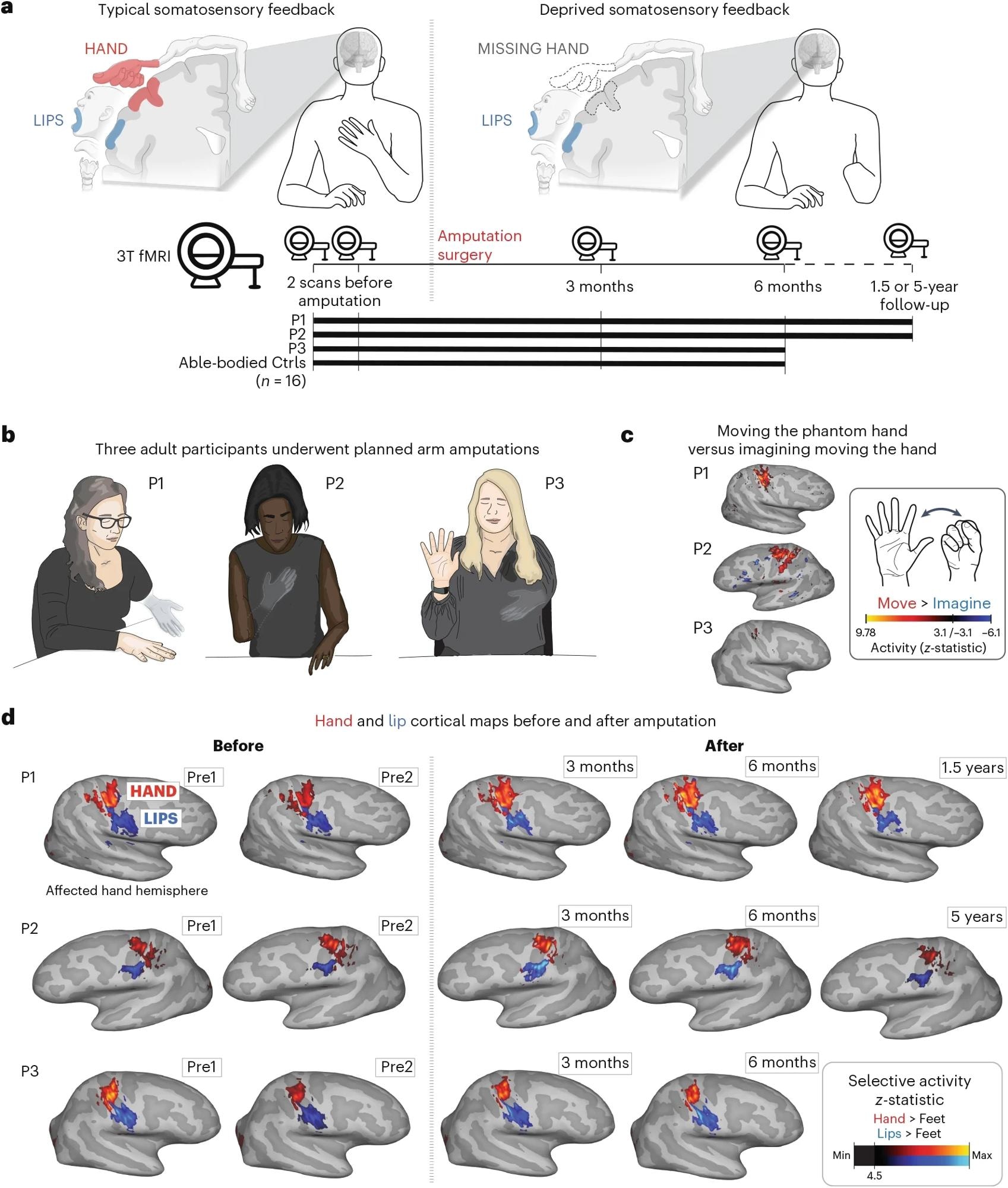 A, chronologie expérimentale. Des analyses avant et après l'amputation ont été effectuées sur 4 à 5 points de temps: deux fois avant et à 3 mois, 6 mois et 1,5 (P1) / 5 ans (P2) après l'amputation. B, illustration représentant les trois participants 6 mois après l'amputation, y compris leur description subjective de leur position de membre fantôme. C, les mouvements fantômes ne sont pas imaginaires. Carte de contraste de l'activité univariée (Z-Sored) affichant les tentatives d'un participant d'ouvrir et de fermer la main fantôme par rapport à l'imagination du mouvement, 6 mois après l'amputation. D, les cartes d'activation corticales de la main (rouge) et des lèvres (bleues) (contrastées avec les mouvements des pieds) dans l'hémisphère de la main affecté à travers 4 à 5 séances. Toutes les cartes ont été minimales à 33% de la statistique Z maximale et ont utilisé une échelle de couleurs commune (la statistique Z maximale du participant> 4,5). Les participants ont convenu que leur image reproduit. Les illustrations cérébrales en A ont été créées dans Biorender. »></p>
<p style=