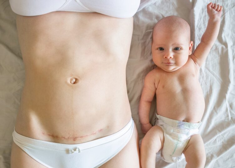 Closeup of woman belly with a scar from a cesarean section and her baby