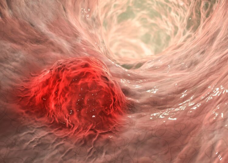 3D illustration showing malignant tumor in intestine