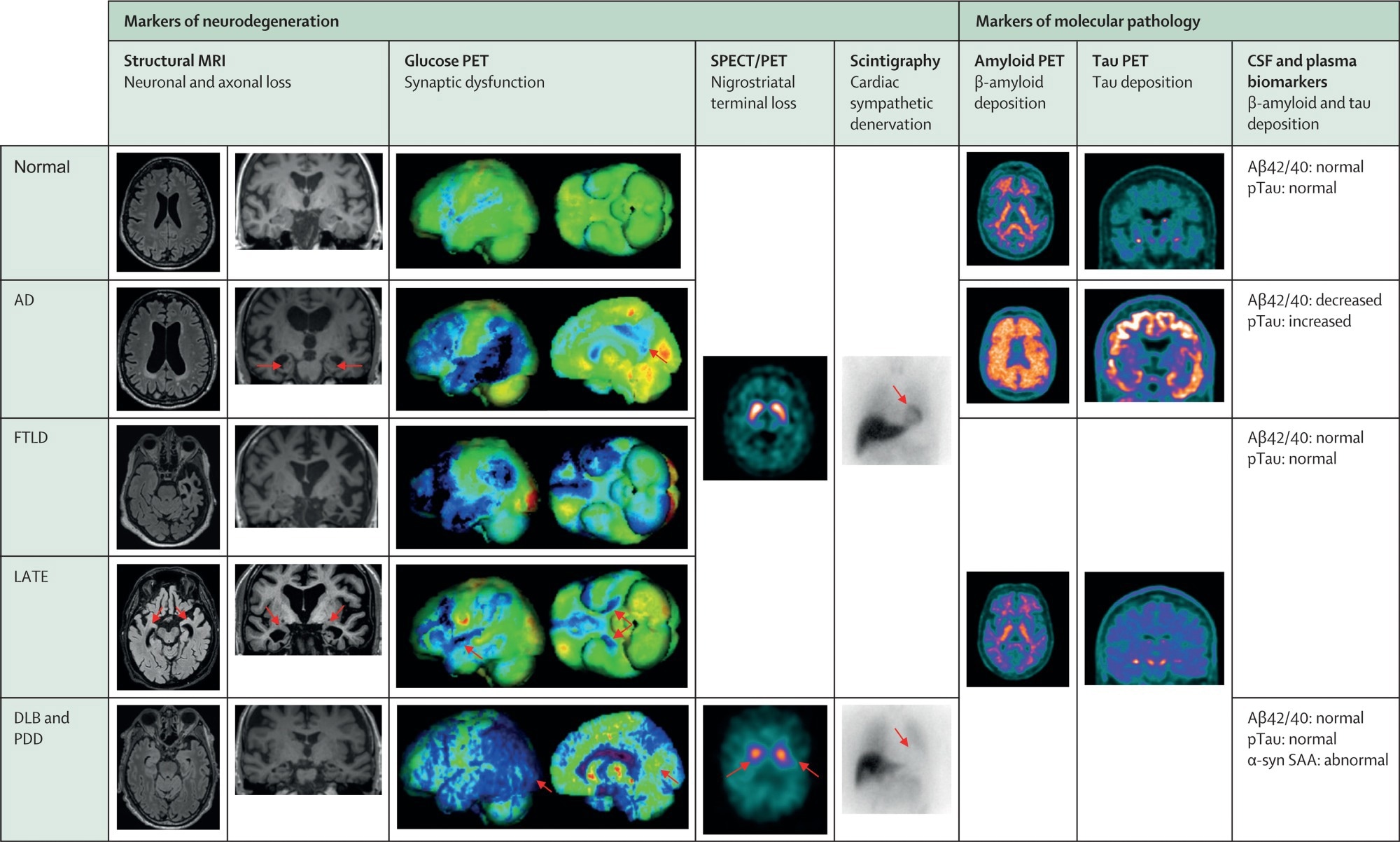 Profils de biomarqueurs typiques à travers les troubles cognitifs neurodégénératifs de pathologie pure. La couleur bleue dans les rendus en glucose pour animaux de compagnie dénote un hypométabolisme substantiel. Les couleurs orange / rouge / violet / blanc dans l'imagerie SPECT Nigrostriatal et l'amyloïde et le TAU PET indiquent une absorption accrue du traceur. Les images proviennent des archives de l'un des co-auteurs (VG).