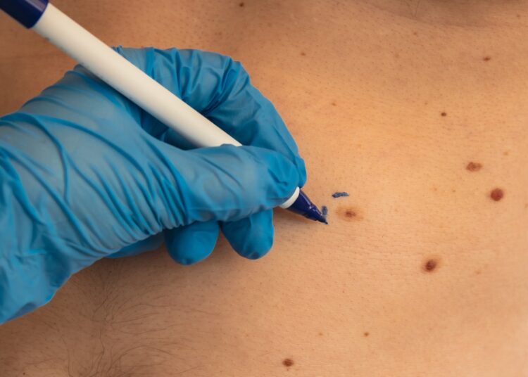 Study: Nicotinamide for Skin Cancer Chemoprevention. Image Credit: yanishevska / Shutterstock