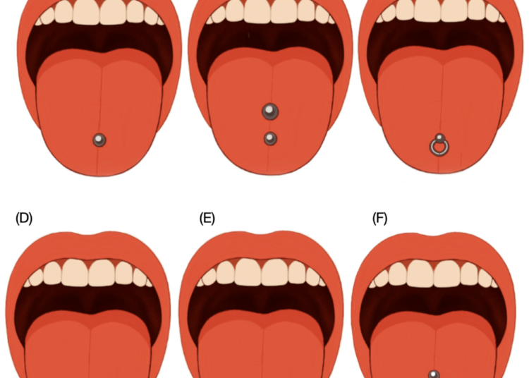 Schematic diagram illustrating the most common sites for tongue piercings. (A) Single middle tongue; (B) double piercing in midline; (C) ring piercing; (D,E) double piercing horizontally and (F) multiple piercing usually involving two or more piercings arranged in a row or symmetrically on either side of the midline.
