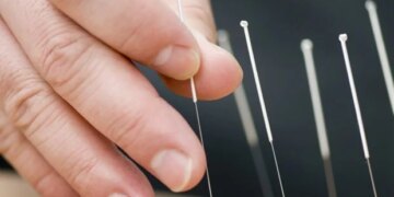 L'aiguilletage sous-cutané de Fu offre une thérapie non pharmacologique sûre pour les douleurs musculaires